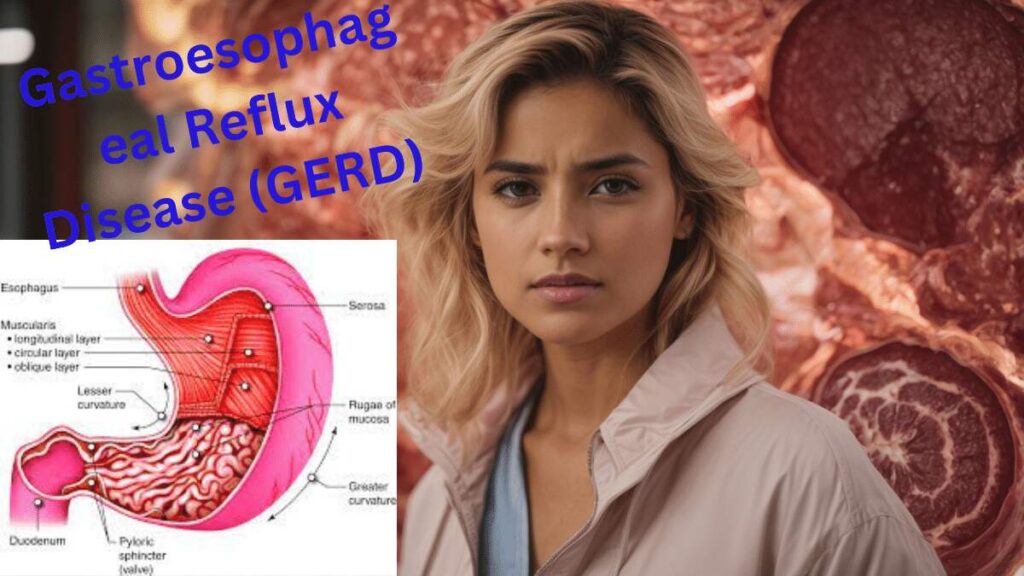 Gastroesophageal-Reflux-Disease-GERDf